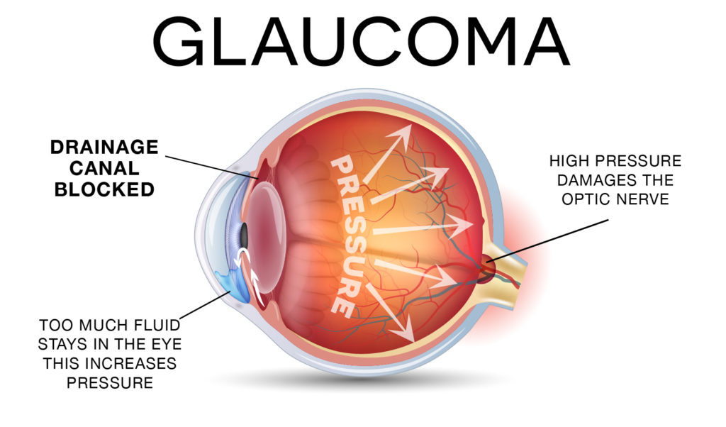 best-glaucoma-treatment-in-mumbai-infiniti-eye-hospital